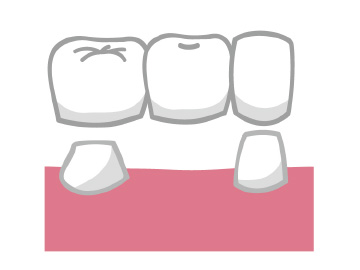 抜歯のブリッジ治療