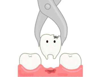 虫歯の抜歯作業